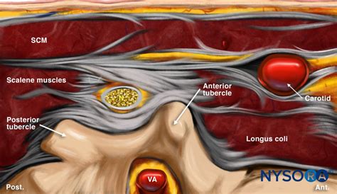 illustrazione di infiltrazione periradicolare cervicale con ago e sonda ecografica