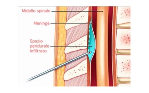 Grafico semplificato sull'efficacia delle infiltrazioni epidurali nel tempo