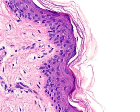 Sezione istologica di corioangioma placentare