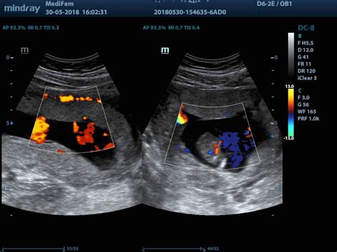 Ecografia Color Doppler di un corioangioma placentare