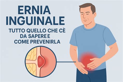 Schema delle diverse tipologie di ernia (inguinale, ombelicale, crurale, iatale)