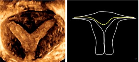 Rappresentazione anatomica dell'utero con setto