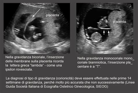 Complicazioni della gravidanza gemellare