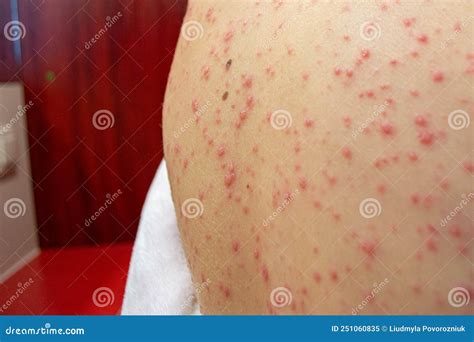 bambino con eruzione cutanea da varicella