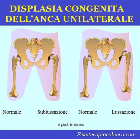 Illustrazione di come applicare un doppio pannolino per la displasia dell'anca