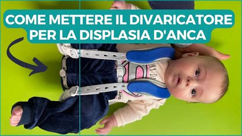 Esempio di tutore ortopedico per la displasia dell'anca