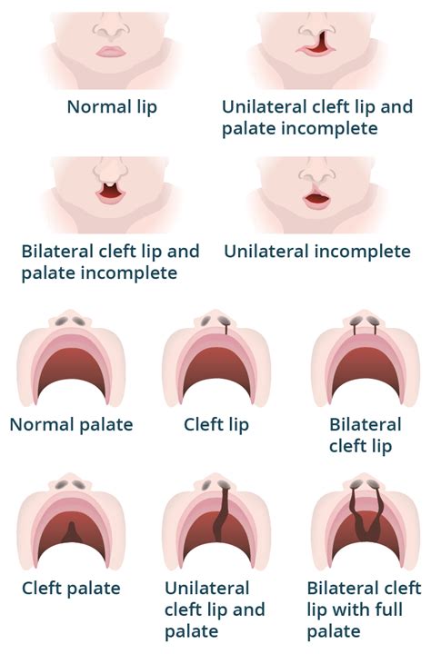 Illustration of a newborn with cleft lip and palate