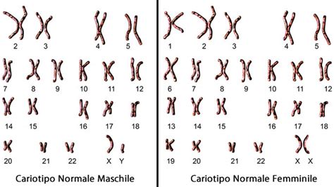 Rappresentazione schematica del cariotipo femminile normale (XX) e della sindrome di Turner (X)