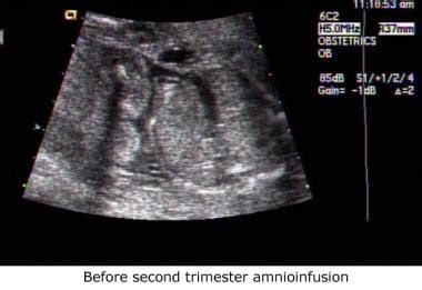 Amnioinfusione