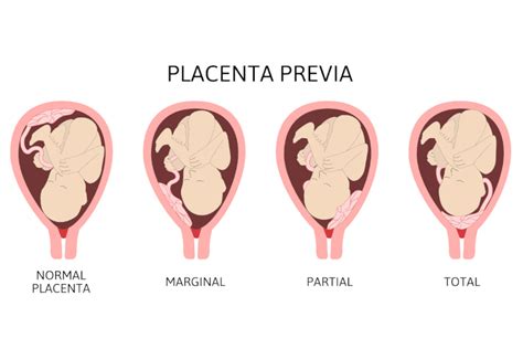 Infografica che illustra le diverse posizioni della placenta: anteriore, posteriore, fundica, laterale e previa