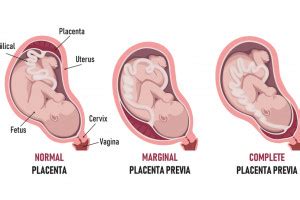 Placenta anteriore e percezione dei movimenti fetali