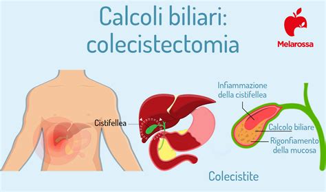 Diagramma della gravità dei sintomi dei calcoli biliari