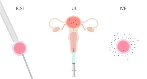 Schema dei diversi livelli di PMA (IUI, IVF, ICSI)