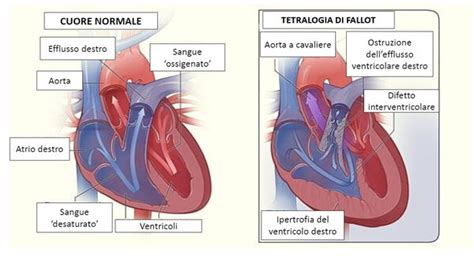 Rappresentazione schematica delle quattro anomalie della Tetralogia di Fallot