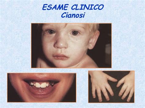 Bambino con cianosi (colorazione bluastra delle labbra e delle estremità)