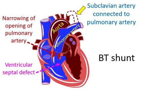 Schema di un intervento di shunt di Blalock-Taussig