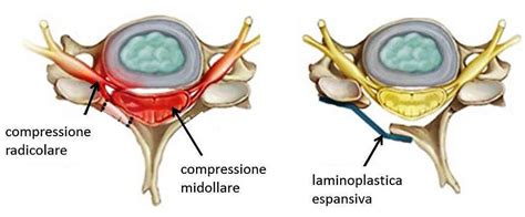 Sintomi comuni di compressione del midollo spinale