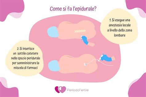 Mamma in travaglio con catetere epidurale
