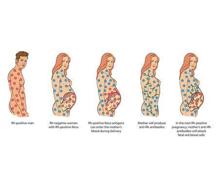 Incompatibilità Rh materno-fetale