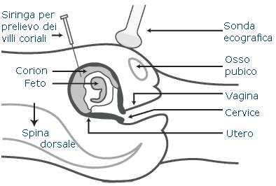 Schema villocentesi transaddominale