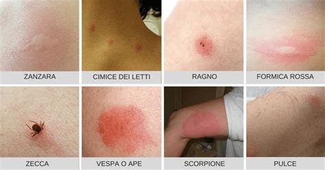 Confronto tra eritema solare e punture d'insetto