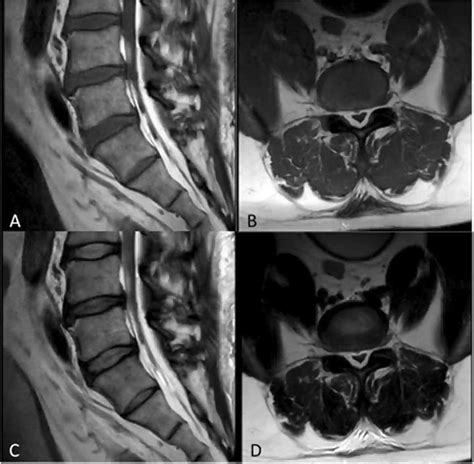 Immagine RM di lipomatosi epidurale spinale