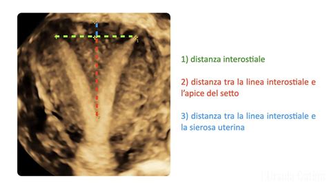 Visualizzazione 3D dell'endometrio uterino