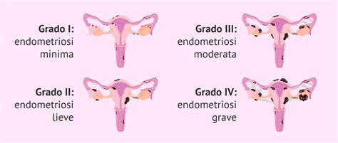 Rappresentazione di endometriosi