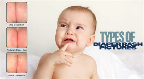 Doctor examining a baby for diaper rash