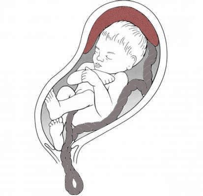 Rappresentazione del prolasso del cordone ombelicale