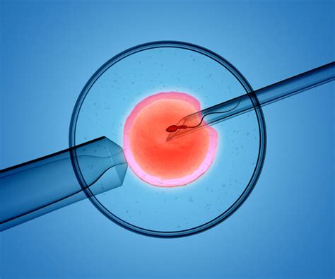 Donne che scelgono la ICSI su ciclo spontaneo