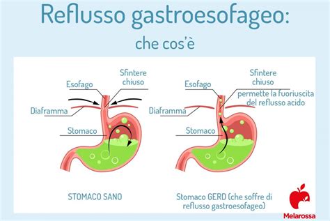 Infografica Sintomi Reflusso Gastroesofageo nel Neonato