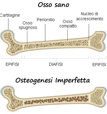 Ecografia di Samuel Norbert Avery con diagnosi di Osteogenesi Imperfetta
