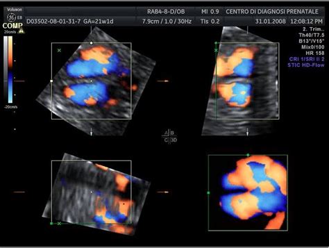 Ricostruzione 4D del cuore fetale con tecnica STIC