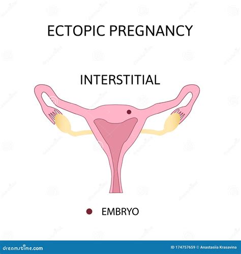 Meccanismi di gravidanza extrauterina post-FIVET/ICSI