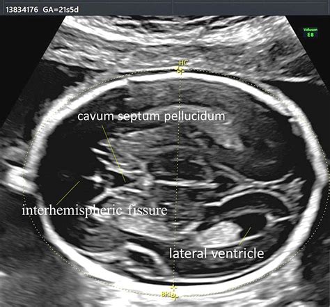 ultrasound image of fetal ventricles