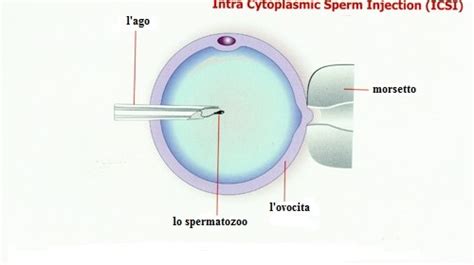 Diagramma della procedura ICSI con ago e ovocita
