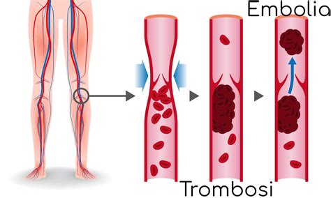 Diagramma che illustra il sistema venoso e i rischi di trombosi