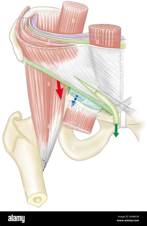 Schema anatomico dell'ernia inguinale