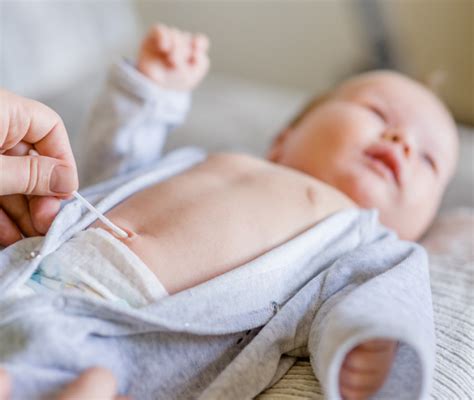 Granuloma ombelicale nel neonato