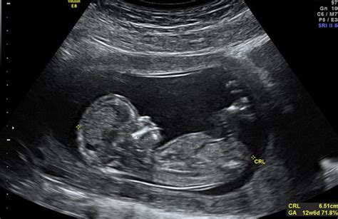 Misure biometriche fetali in ecografia