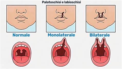 Diagramma delle diverse forme di palatoschisi