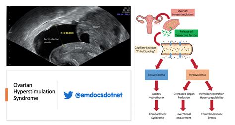 Ovarian hyperstimulation syndrome diagram