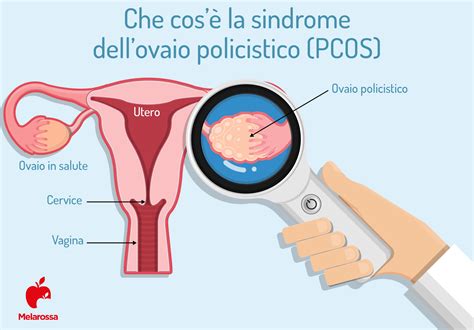 Rappresentazione delle ovaie con sindrome policistica