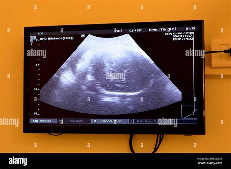 Ecografia che mostra un feto in utero