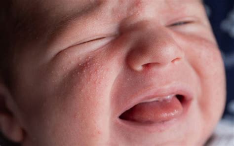 Milia sul viso di un neonato