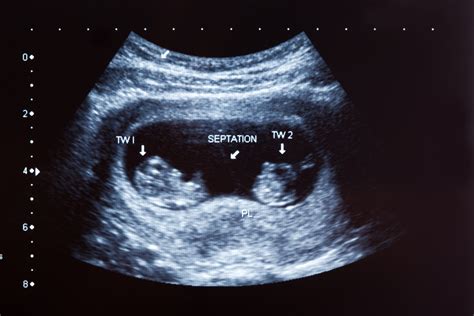 Twins ultrasound