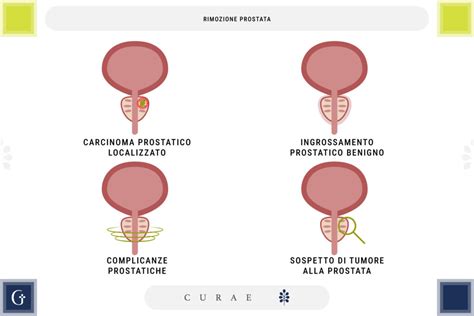 Diagramma della prostata ingrossata e uretra compressa