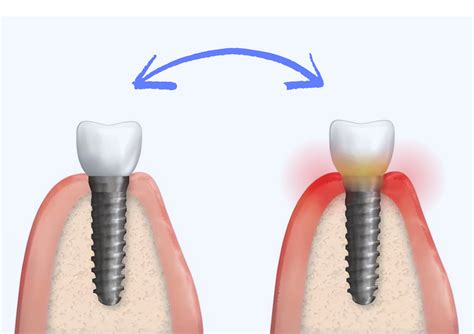 Sintomi e progressione della mucosite perimplantare
