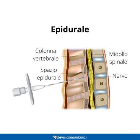 Procedura di Anestesia Epidurale per il Parto
